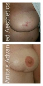 3D Areola Cosmetic tattooing